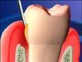 Atridox - an antibiotic treatment